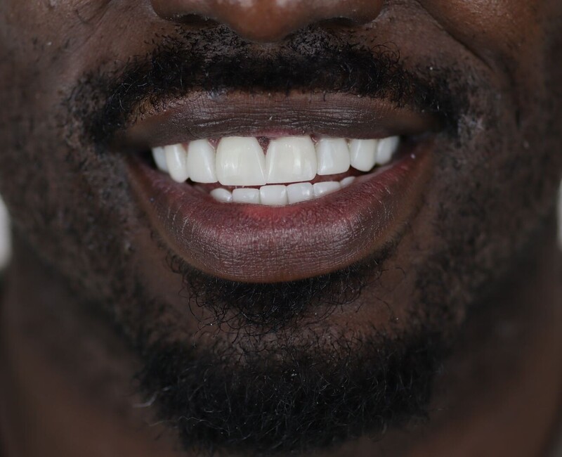 Refined Veneers That Look and Feel Natural: Key Benefits 